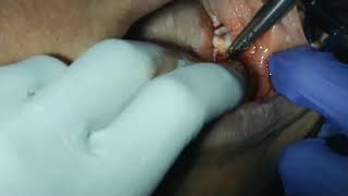 live  grossly decayed molar extraction with magnetic mallet  by drcmurugavel [upl. by Enelrahc]