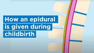 How an epidural is given during childbirth  Bupa Health [upl. by Glenna]