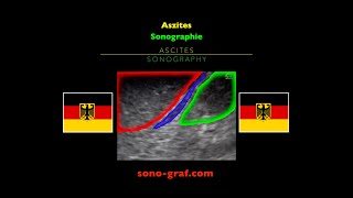 Sonographie Aszites [upl. by Consalve]