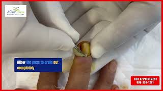 Paronychia fingernail abscess infection treatment  Fingernail Abscess Removal in Gurgaon [upl. by Carce]