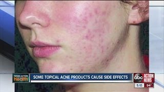 Some acne treatments cause side effects [upl. by Skurnik]