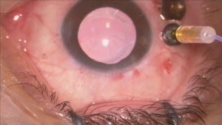 Retinal detachment in eye with Radial Keratotomy Lukan Mishev Live Stream [upl. by Ama407]