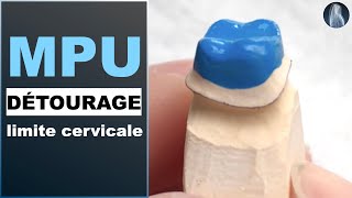 Limite cervicale MPU  Modèle sectorisé  Prothèse dentaire  © [upl. by Xantha]