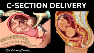 Caesarean Delivery CSection Complete Animation Video for Mommies to be [upl. by Alemahs]