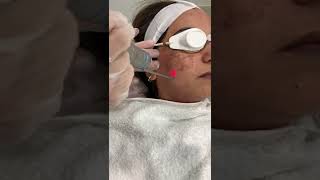 QSwitched Laser Toning pigmentation removal [upl. by Chaille]