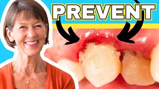 How To Treat Gingivitis And Gum Recession At Home [upl. by Adnilrem]