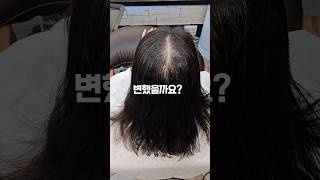 휑한 정수리 벌어지는 가르마 모류교정 링거펌 뿌리볼륨펌 koreanhairstyle 링거펌 모류교정 탈모커버펌 [upl. by Anaer]