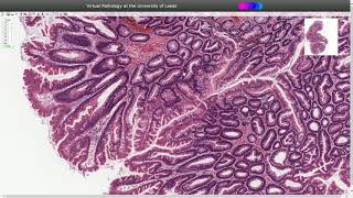 Traditional Serrated Adenoma  Histopathology [upl. by Zasuwa]