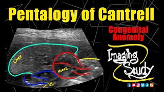 Pentalogy of Cantrell  Gastroschisis  Ectopia Cordis  Ultrasound  Anomaly  Case 289 [upl. by Cheney]