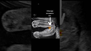 Ultrasound Scan Showing Baby Girl 👧 oldwivestales status pregnancy educational [upl. by Sanborne297]