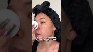 Dont Struggle with Hormonal Acne amp Cystic Bumps [upl. by Greeley]