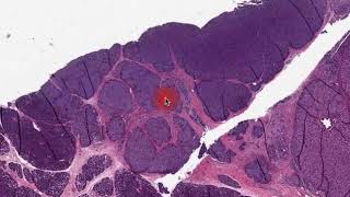 Digital Surgical Pathology pancreas Acinar Carcinoma [upl. by Assenab]