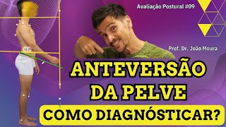 COMO IDENTIFICAR A ANTEVERSÃO PÉLVICA E SUA GRAVIDADE Avaliação Postural 09 [upl. by Lleinad422]