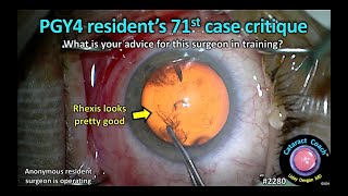 CataractCoach™ 2280 PGY4 residents 71st cataract case critique [upl. by Nywde718]