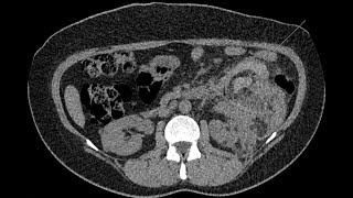 Hemorrhagic renal angiomyolipoma in a tuberous sclerosis phakomatosis patient [upl. by Ahtelahs383]