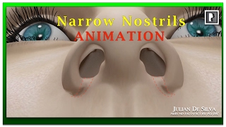 Rhinoplasty Animation  How can Wide Nostrils be Narrowed [upl. by Bettzel227]