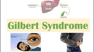 Gilbert Syndrome  Causes Genetics Pathogenesis Signs amp Symptoms Diagnosis Treatment [upl. by Atinar]