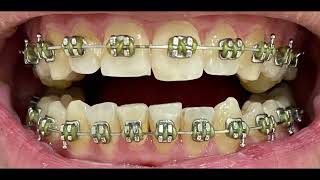 Before and After Braces timelapse over 2 Years Time monthly updates with two lower extractions [upl. by Anihsit]