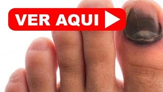 ATENCION Las MANCHAS NEGRAS en las uñas puedes ser de GRAN RIESGO  Melanoma Maligno [upl. by Alyos]