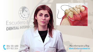 Periodontitis tratamiento · Dental Internacional [upl. by Aileve]