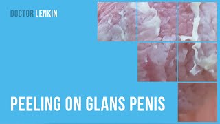 ➡ Peeling on glans penis [upl. by Airun]