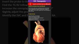 TEE Transgastric Superior and Inferior Vena Cava Bicaval [upl. by Eelyrehc]