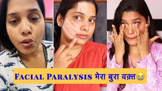 Suffering From Facial Paralysis  Bells palsy sapnaprabhat [upl. by Sayles]