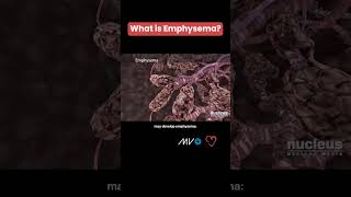 What is Emphysema COPD 🫁 [upl. by Aikenahs]