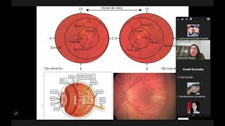 Retinopatía del prematuro y retinopatía diabética Parte 1 [upl. by Rape888]