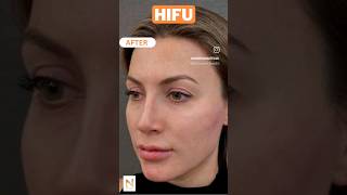 HIFU Treatment Before After Results skincare facelift hifufacelifting hifutreatment saggyskin [upl. by Sreip]