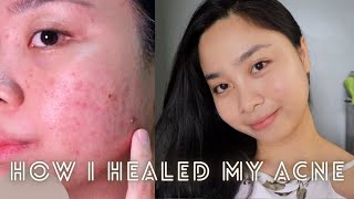 How I healed my acne  Paano nawala ang pimples ko  Arvie Ramos [upl. by Ahsael]