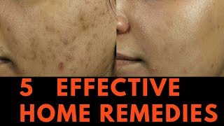 5 EFFECTIVE Home Remedies for Skin Pigmentation Brown Spots and freckles [upl. by Neved853]