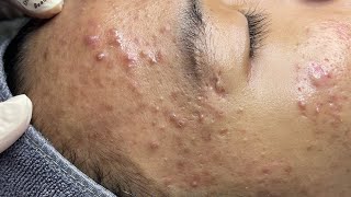 ACNE TREATMENT VU QUYNH MI  Perennial Blackheads On Boy Face 2024FULL [upl. by Ettenom514]