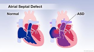 Quick review  Atrial Septal Defect  Congenital Heart Disease 2 [upl. by Olsson]