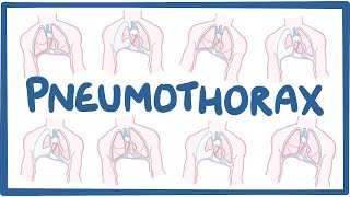 Pneumothorax  causes symptoms diagnosis treatment pathology [upl. by Liauqram]