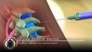 Cervical Epidural Steroid Injection Procedure Animation [upl. by Doner]