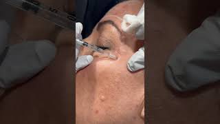 Botox for crow’s feet 10 units on each side botox aesthetics aestheticdoctor [upl. by Ephrem]