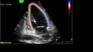 ABNORMAL STRAIN LONGITUDINAL ECHO [upl. by Kirima]