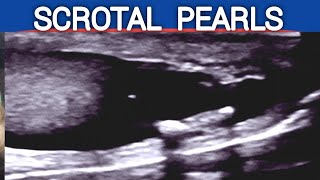 Scrotal PEARLS  Ultrasound  Causes  Association with Infertility and Oligospermia [upl. by Eloccin]