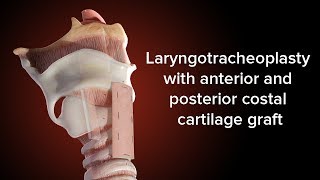 Medical Animation Anterior and Posterior Cricoid Split  Cincinnati Childrens [upl. by Akcimehs277]