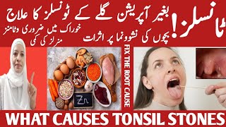 Tonsil Stones Removing The Deeper Cause Tonsillitis Home Remedies Gala Pak Jane Listen Your Body [upl. by Osi436]