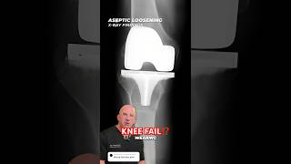 Knee Replacement Failure Xray Discussion shorts [upl. by Frodina]