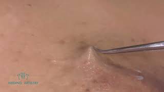 Ingrown Hair Extraction  Episode 14  Expand Your Mind [upl. by Jonah]