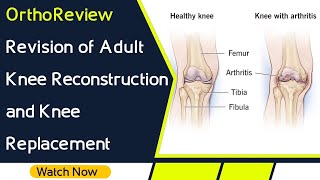 OrthoReview  Revision of Adult Knee Reconstruction and Knee Replacement for Orthopaedic Exams [upl. by Chelsae517]