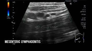 Mesenteric lymphadenitis I Mesenteric lymphadenopathy [upl. by Erdnaed552]