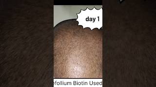 biotin hair growth results before and after  biotin side effect  refollium biotin results  biotin [upl. by Noerb68]