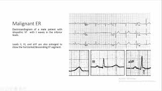 early repolarization [upl. by Mandelbaum774]