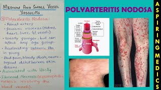 Polyarteritis nodosa pathology lectureVasculitis part 2 ASPIRING MEDICS [upl. by Singleton]