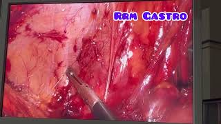 Laparoscopic Mesh repair TAPP method [upl. by Yhtomot]