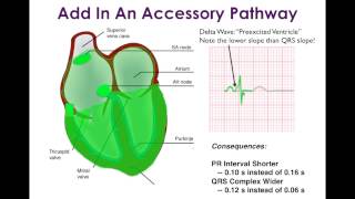 WolffParkinsonWhite WPW and Associated Arrhythmias [upl. by Iba]